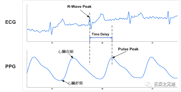 ECG