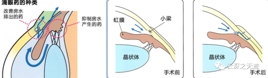 眼压传感器