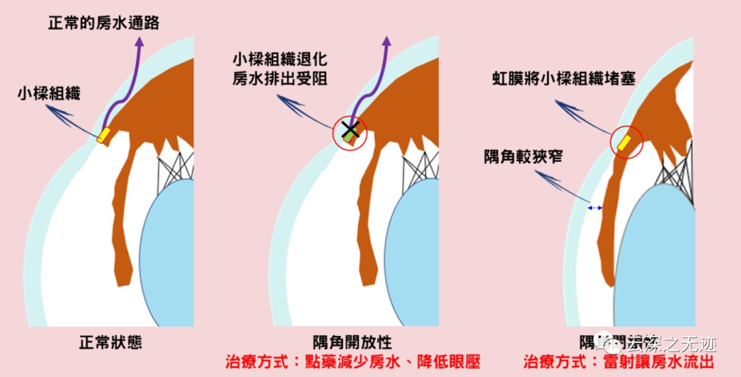 眼压传感器