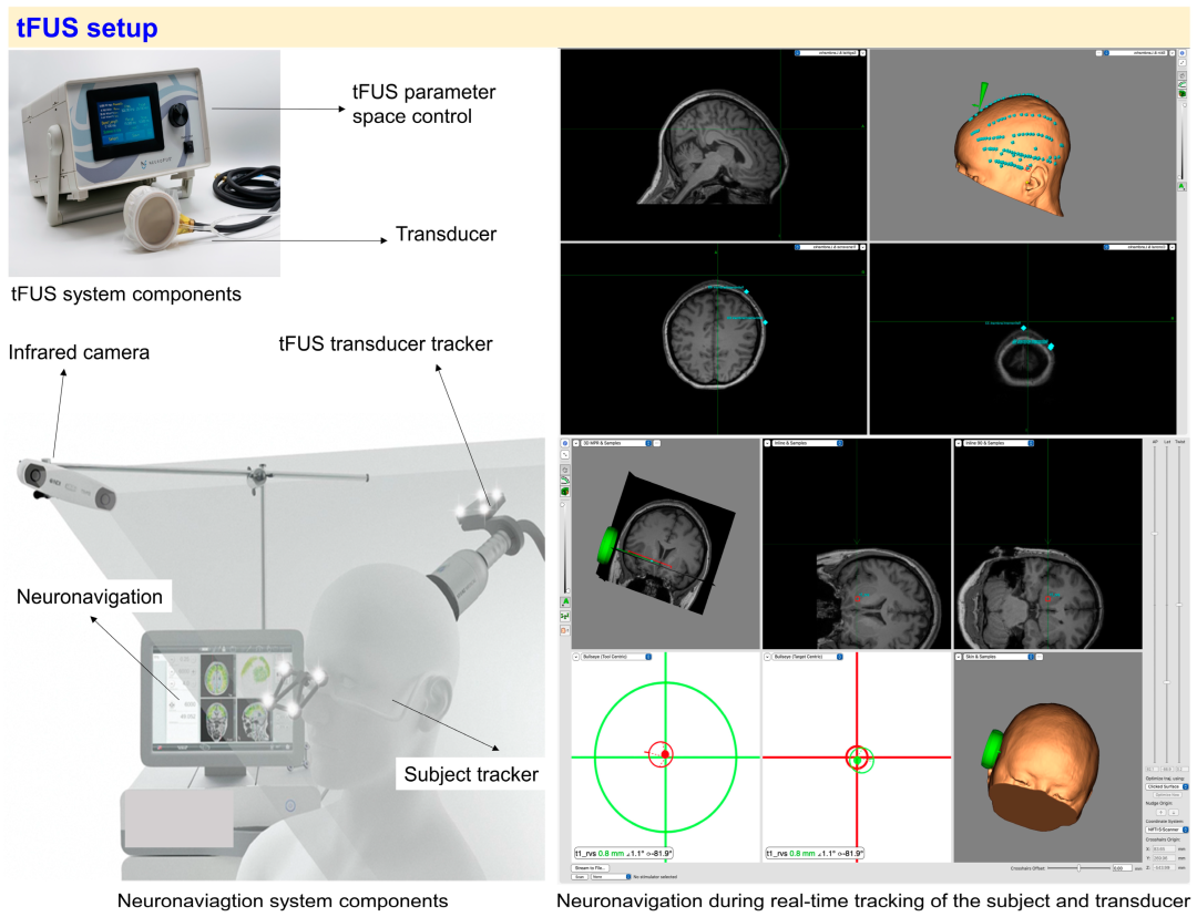 经颅聚焦超声（tFUS）其临床有效性如何？
